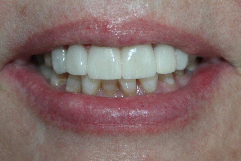 Before and After Procedure Results Image