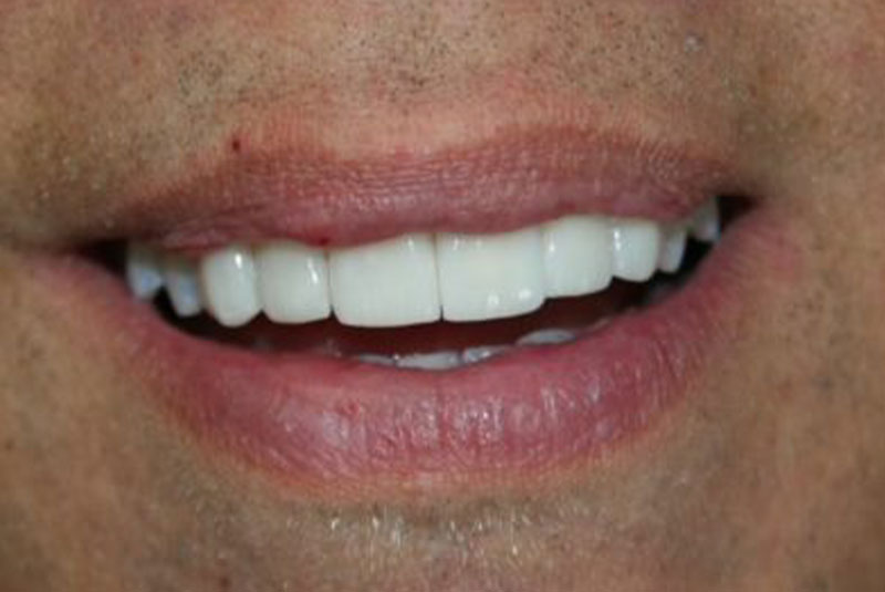 Before and After Procedure Results Image