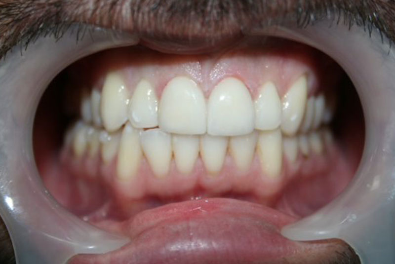 Before and After Procedure Results Image