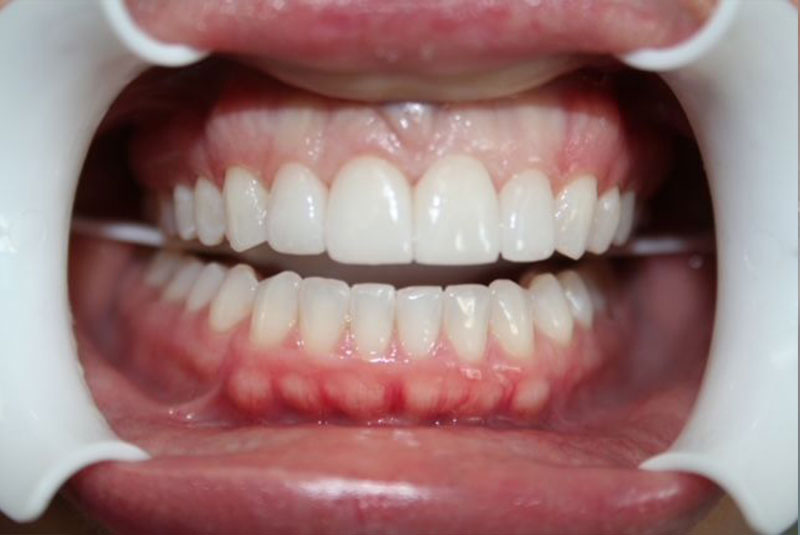 Before and After Procedure Results Image