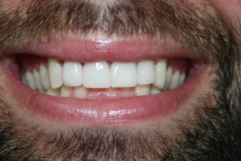 Before and After Procedure Results Image