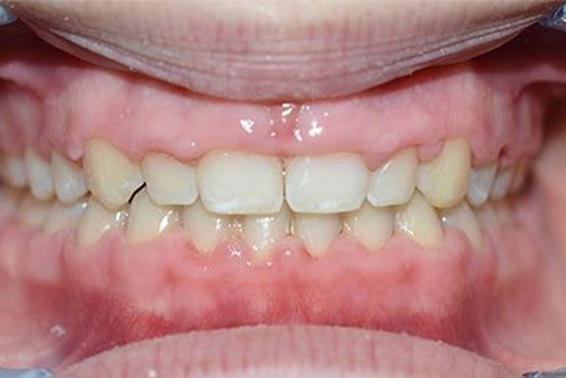 Before and After Procedure Results Image