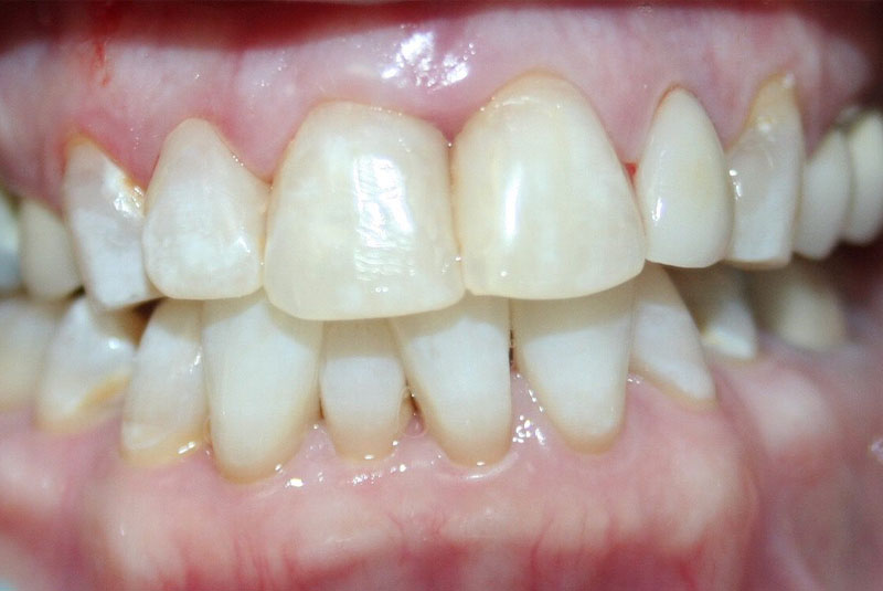 Before and After Procedure Results Image