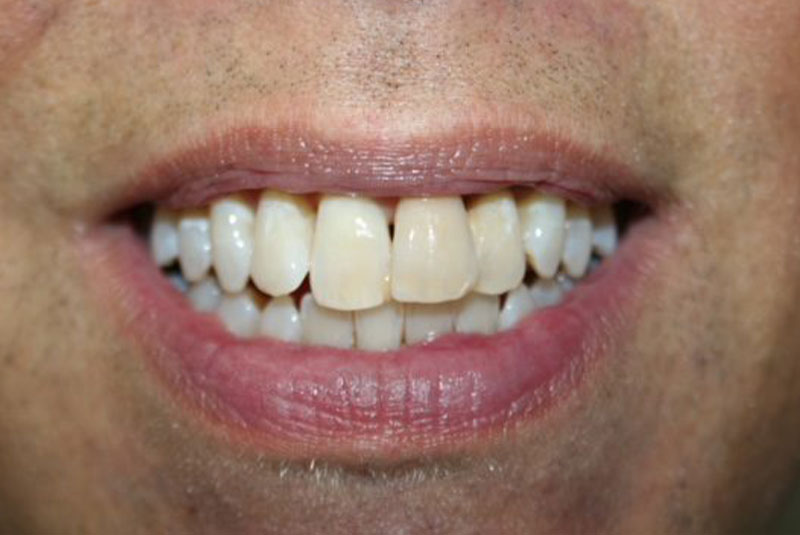 Before and After Procedure Results Image