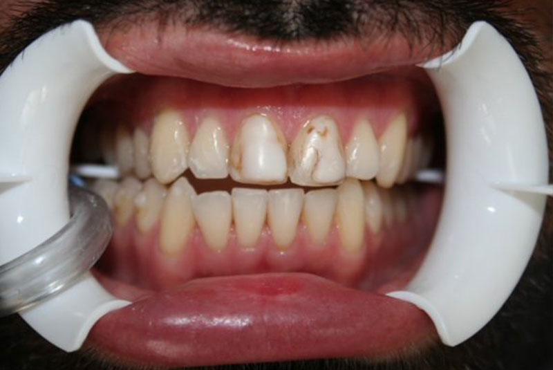 Before and After Procedure Results Image