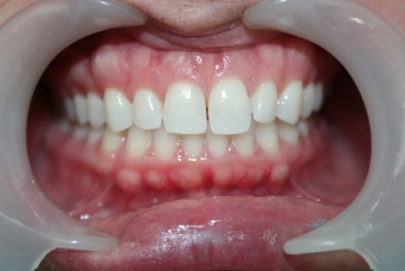 Before and After Procedure Results Image