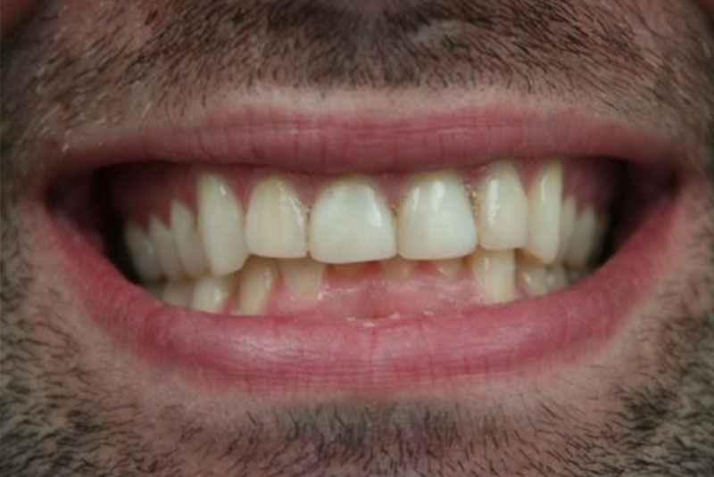 Before and After Procedure Results Image