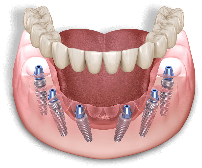 graphical asset of full mouth dental implant
