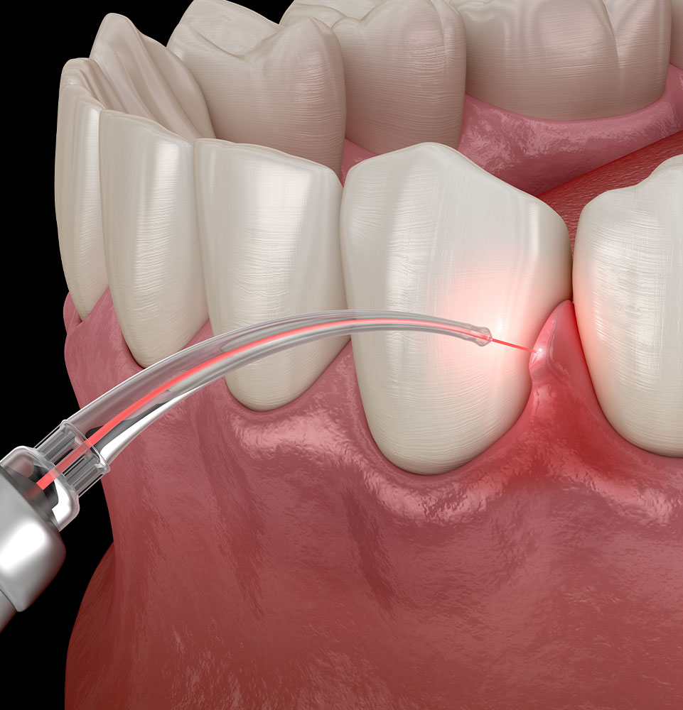 Dental Laser Cleaning gums