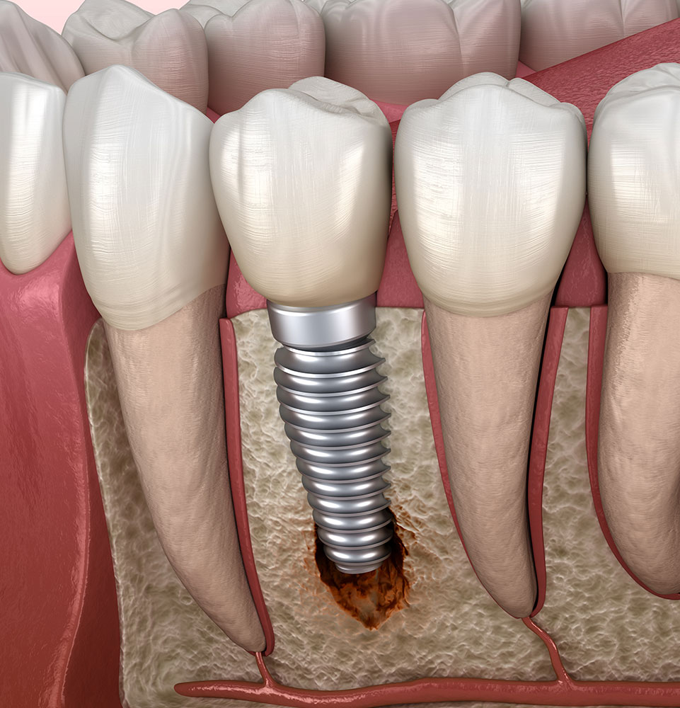 Peri-Implantitis